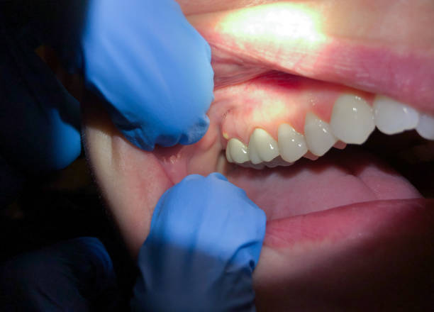Best Dentist for Tooth Abscess  in Tatamy, PA